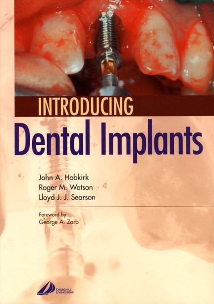 Introducing Dental Implants