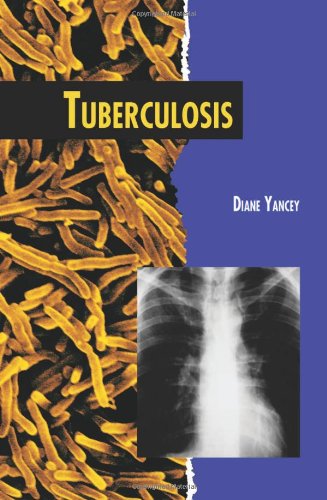 Tuberculosis