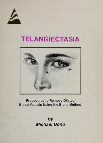 Telangiectasia: Procedures to Remove Dilated Blood Vessels Using the B